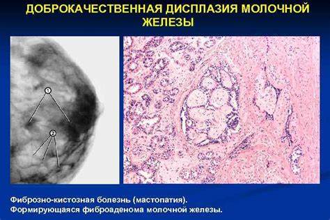 Мастопатия молочной железы диета