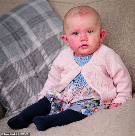 Mother Of Girl Born With Purple Birthmarks Hid Her From Strangers For