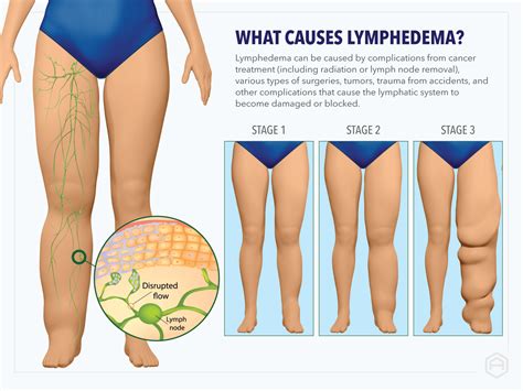 Lymphedema Lymphatic Disorders Cancer Airos Medical