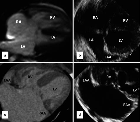 Ventricular Septal Defects Radiology Key Images And Photos Finder