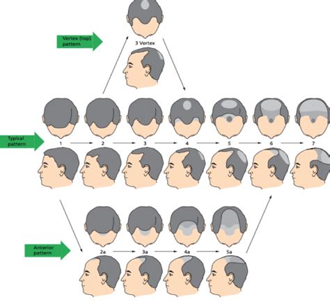 Male Pattern Hair Loss Midland Skin