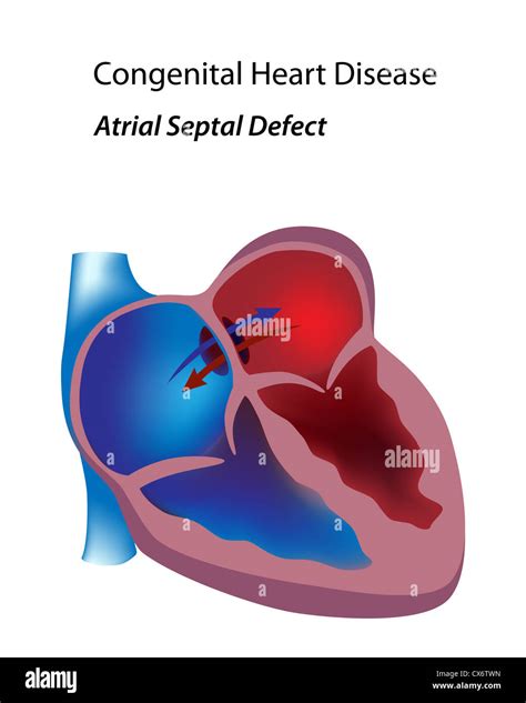 Congenital Heart Disease Atrial Septal Defect Stock Photo Alamy