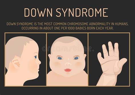 Down Syndrom Symptoms Stock Vector Illustration Of Hand 108727442