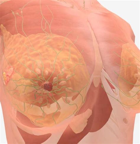 Many stage 4 cancers have subcategories, such as stage 4a or stage 4b, which are often determined by the degree to which the cancer has spread throughout the body. Stage 4 breast cancer symptoms and prognosis