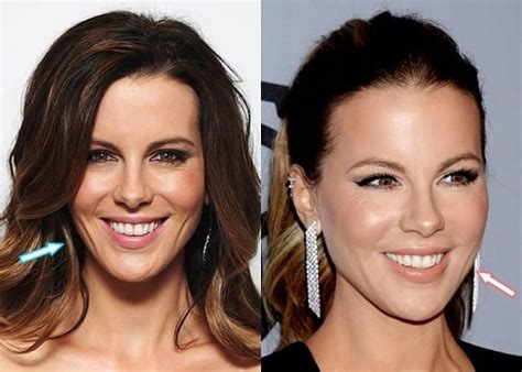 Kate Beckinsale Plastic Surgery Transformation Before And After