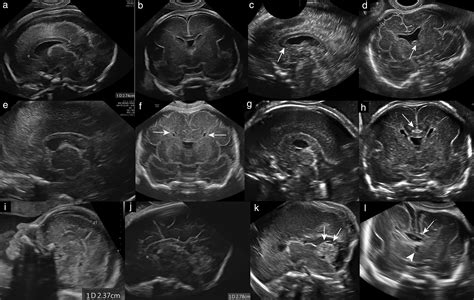 Dedicated Neurosonography For Recognition Of Pathology Associated With