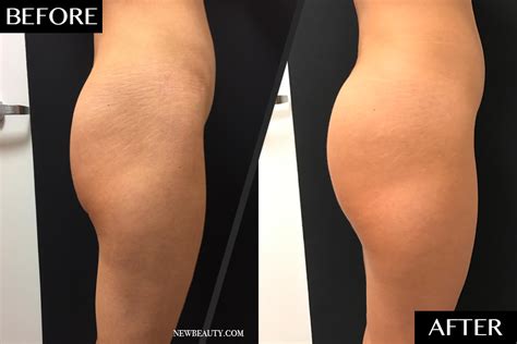 This Is What It Looks Like When You Get A Sculptra Butt Lift