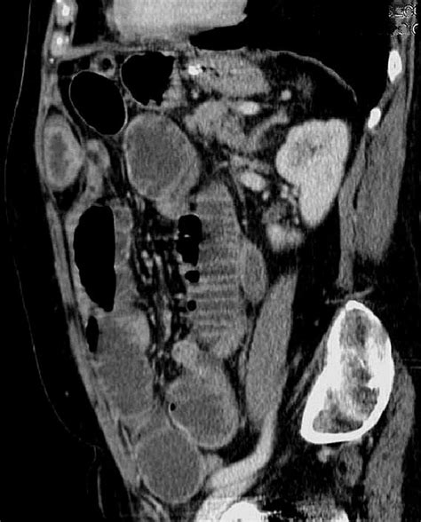 Ct Scan Sagittal View Of Posterior Rectus Sheath Hernia Download