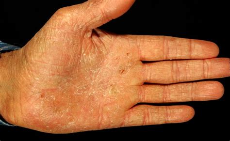 Pompholyx Dyshidrosis Pictures Symptoms Causes And Treatment Otosection