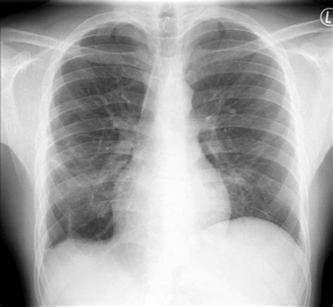 Chest X Ray Two Months Post Bilateral Thoracotomy Fig 5 Chest