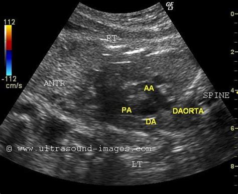 Ultrasound And Color Doppler Videos Fetal Echocardiography Basics The