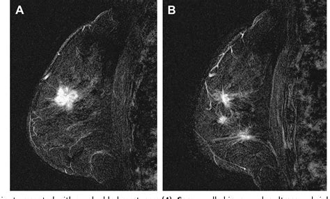 Figure 7 From Evolving Role Of Mri In Breast Cancer Imaging Semantic Scholar