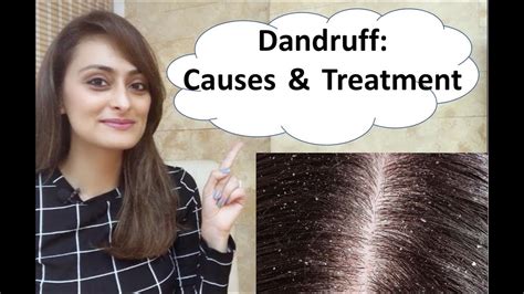 Dandruff Causes And Treatment Seborrheic Dermatitis Youtube