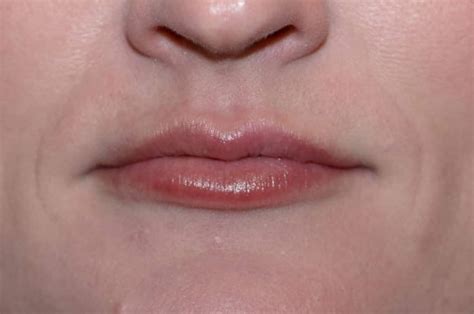 Milia On Lips Pictures