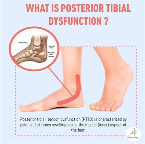 Pain In The Inner Part Of The Ankle Posterior Tibial Tendon Dysfunction