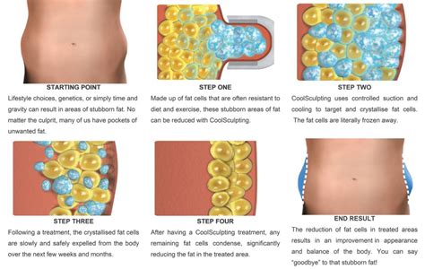 Coolsculpting Remove Fat By Freezing It