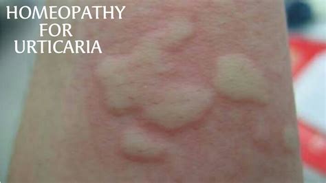 Homeopathy For Urticaria All About Homeopathy