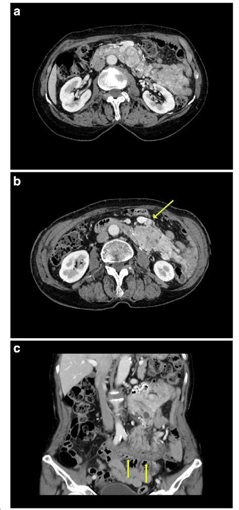 Preoperative Computed Tomography Scans A An 85 × 40 Cm Exophytic