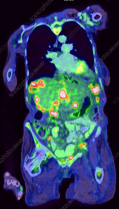 Metastatic Ovarian Carcinoma Pet Ct Scan Stock Image C0393863