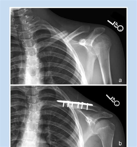 Distal Clavicle Fractures Trauma Orthobullets