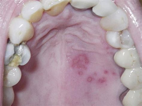 Oral Manifestations Of Viral Infections Atlas Of The Oral And Maxillofacial Surgery Clinics Of