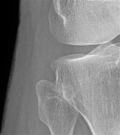 Segond fracture | Image | Radiopaedia.org