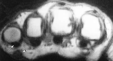 Imaging Of Musculoskeletal Fibromatosis Radiographics