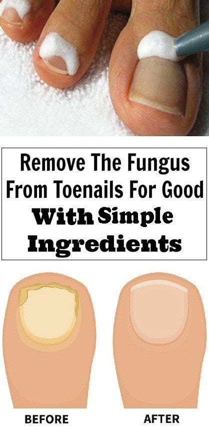 9 Simple Ingredients To Remove The Fungus From Toenails Healthy