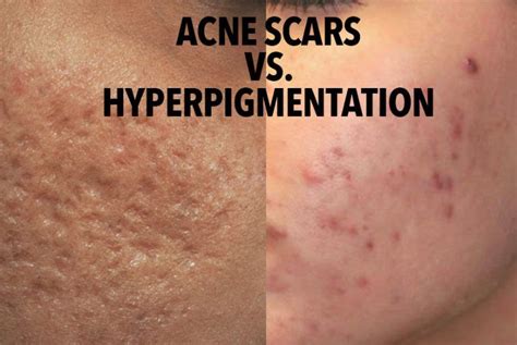 How To Get Rid Of Hyperpigmentation Acne Scars