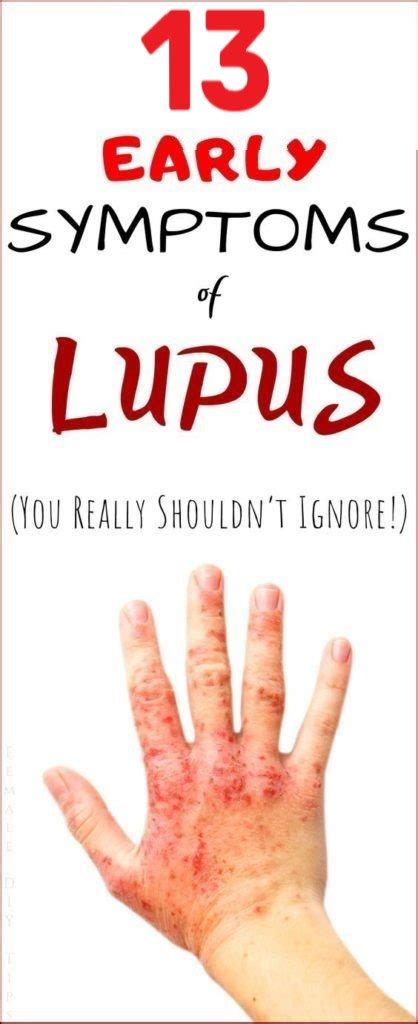 13 Early Warning Signs Of Lupus You Need To Know And What To Do The Moment You See Them