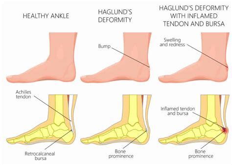 Haglund S Deformity Questions Answered By A Physical Therapist