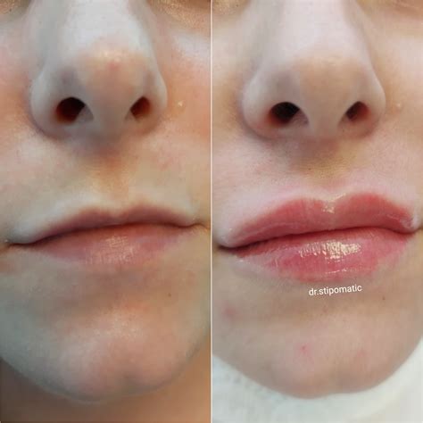 Lip Fillers Maticlinic Aesthetics ǀ Anti Wrinkle Injections ǀ Dermal