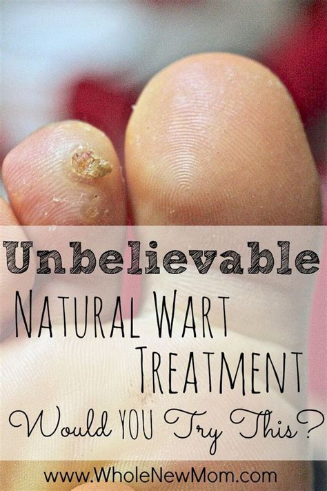 Natural Wart Remedies And One That Really Works Natural Wart Remedies
