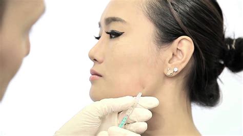 When deciding how many units to get, consider how long it will last but also consider how it will look and feel. V-Shape Jaw Muscle Reduction with Xeomin or Botox - YouTube