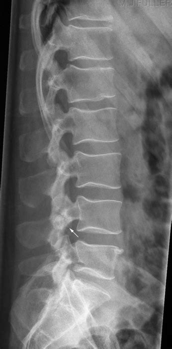 Lateral Lumbar Spine Radiography Wikiradiography