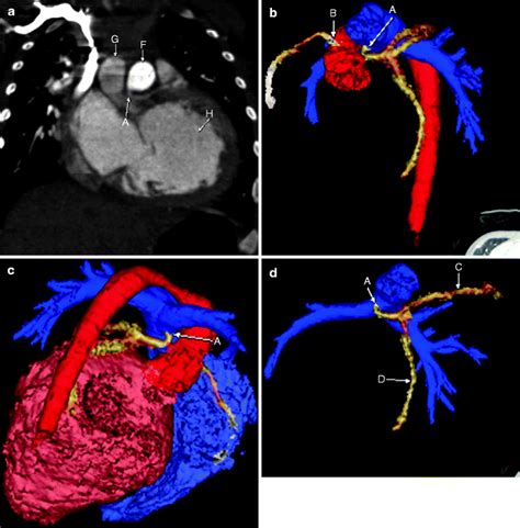 The coronary arteries are the arterial blood vessels of coronary circulation, which transport oxygenated blood to the heart muscle. Evaluation of the Coronary Arteries | Radiology Key