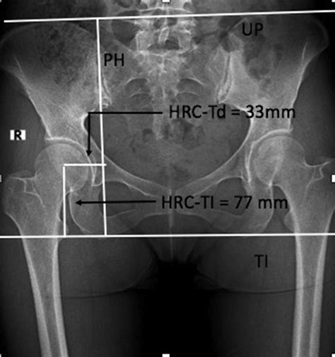 determination of the hrc on the standard ap pelvic radiograph pelvic download scientific