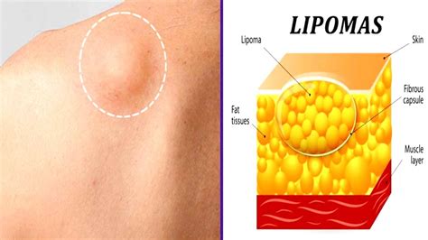 How To Get Rid Of Skin Lumps Lipomas Naturally Youtube