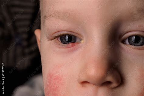 Face Of Little Boy With Red Eyes Inflammation Conjuctivitis Looking