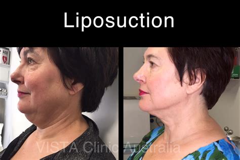 Before And After Vista Clinic Melbourne