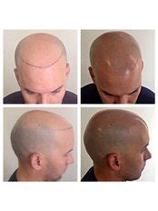 Scalp Micropigmentation in Thailand • Check Prices & Reviews