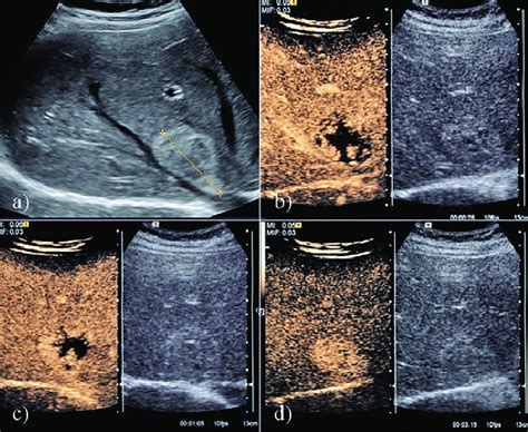 A Hyperechoic Well Delineated Inhomogeneous Nodule Situated In