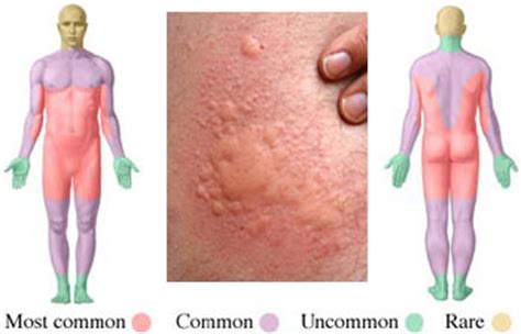 Milia are generally small, around 1 to 2 millimeters in diameter, although some can grow larger. Hives Causes, Symptoms and Treatment Options