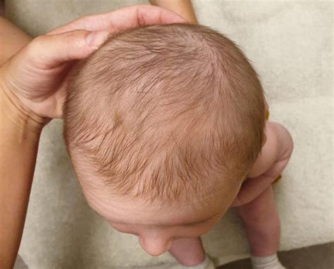 Flat Head Treatment Brisbane Babies And Infants Plagiocephaly Tan