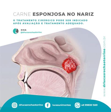 Bola De Carne No Nariz