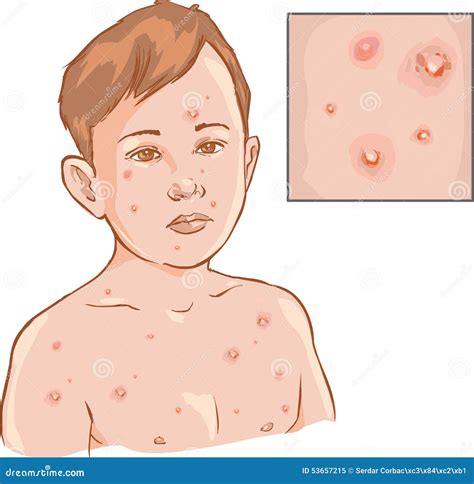 Chickenpox Cartoons Illustrations And Vector Stock Images 889 Pictures To Download From