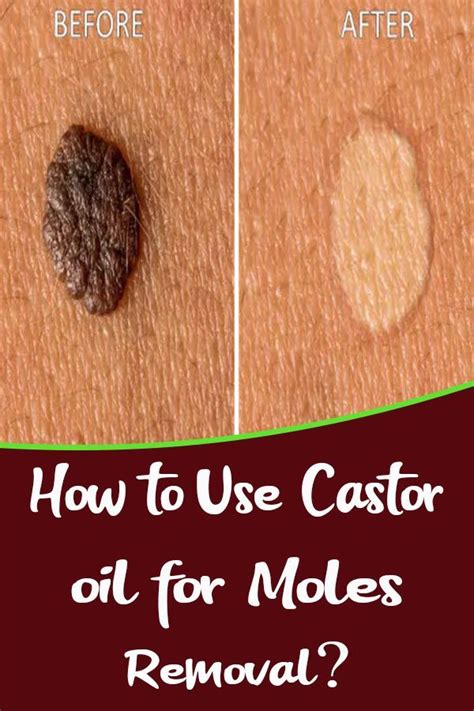 how to use castor oil for moles removal mole removal mole castor oil