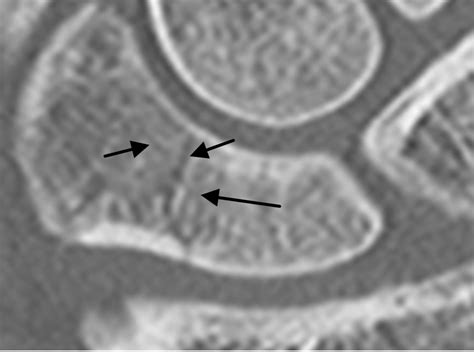 Efficacy of high resolution computed tomography for ...