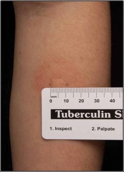 TB Skin Test Mantoux Tuberculin Skin Test TST 2 5