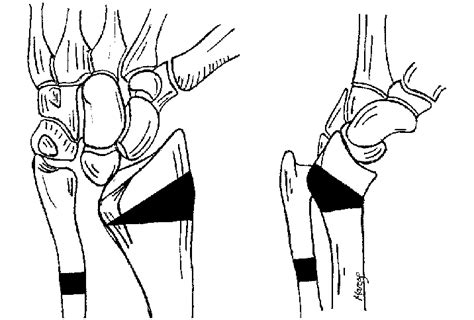 Diagram Showing The Site Of The Radial And Ulnar Osteotomies Shaded